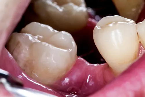 Missing Tooth